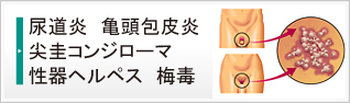 尿道炎　亀頭包皮炎　尖圭コンジローマ　性器ヘルペス　梅毒